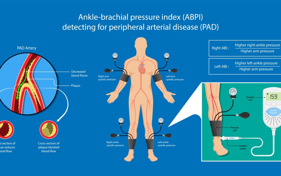 Ankle Brachial Index